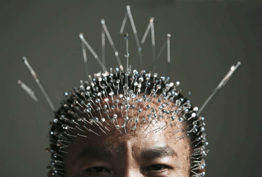 Acupunctura şi emoţiile. Terapii alternative, chiar şi pentru slăbit